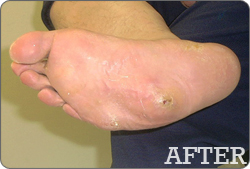 Orthotic solutions for patients with diabetic feet and plantar ulceration - After