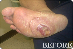 Orthotic solutions for patients with diabetic feet and plantar ulceration - Before